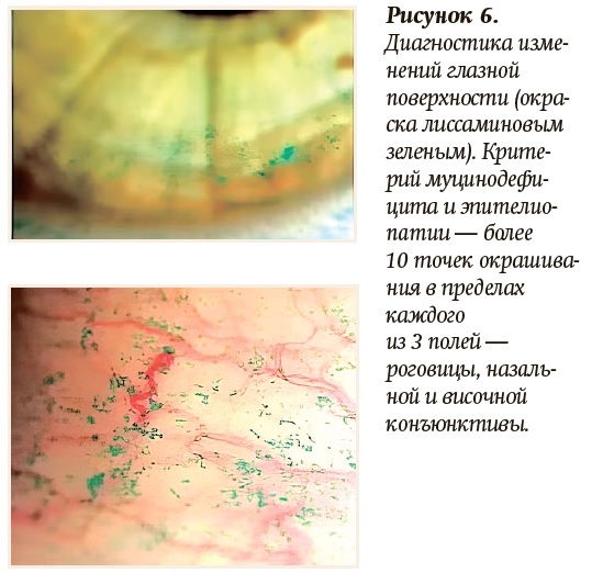 Diagnostika izmenenij glaznoj poverhnosti 23.08