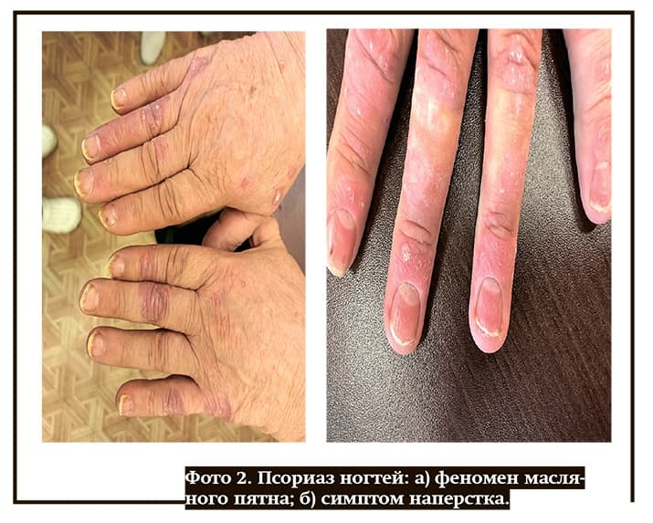 Psoriaz2