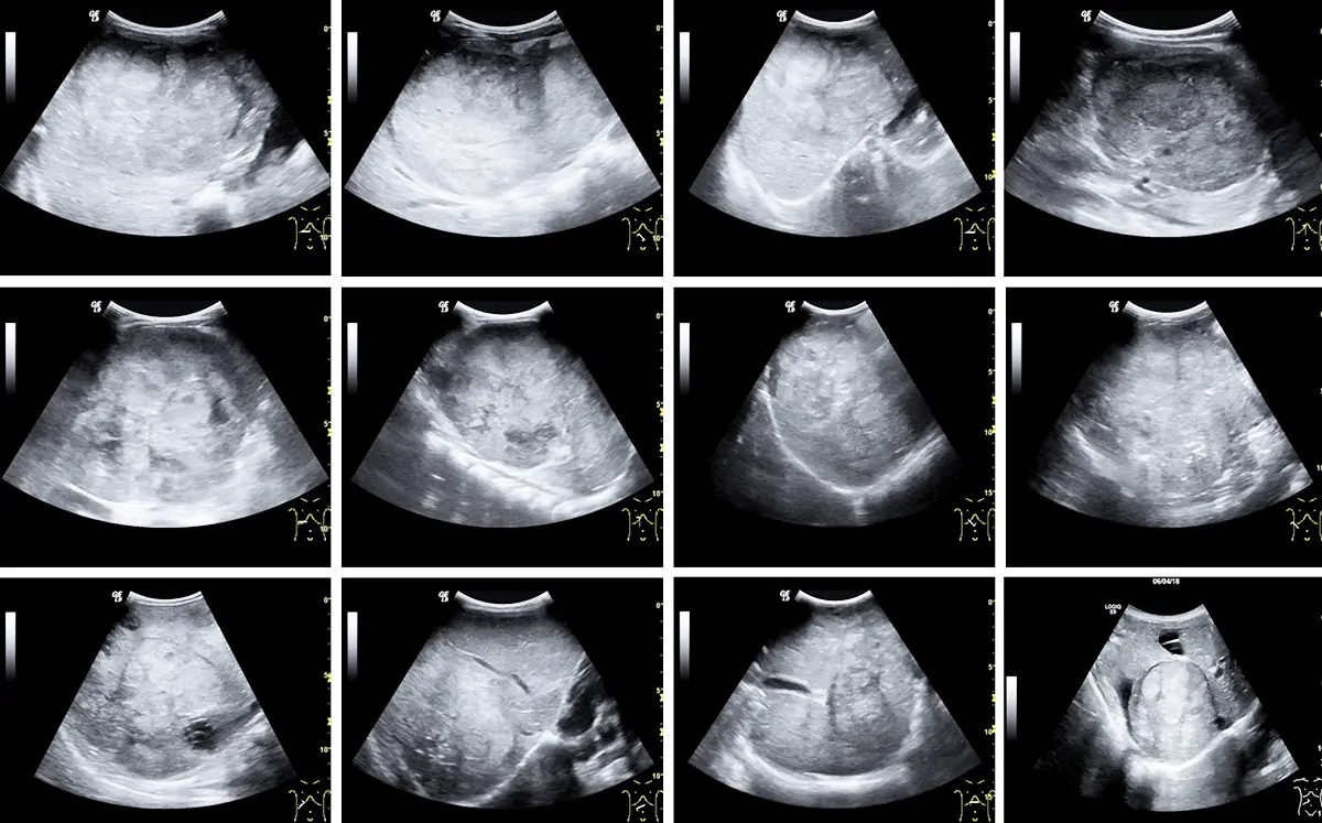 Risunok 1. Sonograficheskie varianty pervichno diagnostiruemoj gepatoblastomy 1