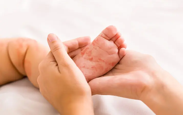 17 января состоится вебинар «Транзиторные состояния и заболевания кожи у новорожденных»