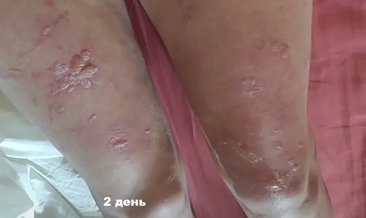 fotodermatoz3.ris 22.07