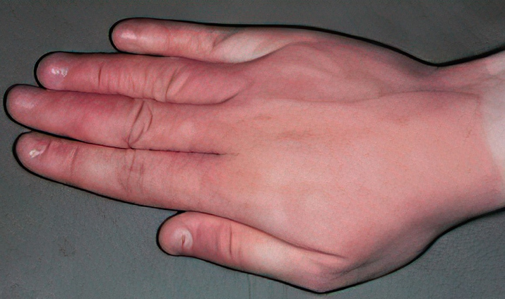 fotodermatoz7.ris 22.07