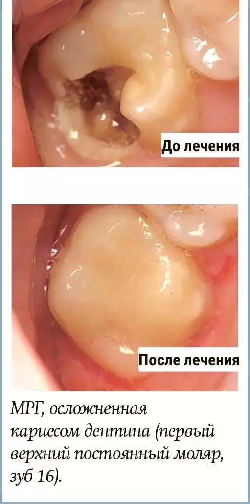 nxbvxg55x