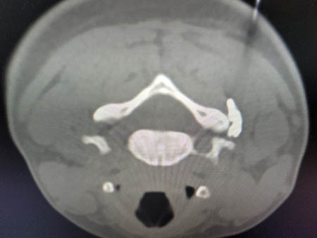 mify osteohondroz 13.04 ris 6