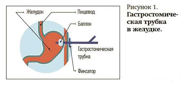 Gastrostomicheskaya trubka 1