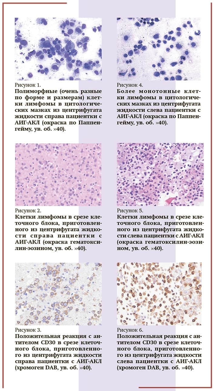 Kletochnye limfomy risunki
