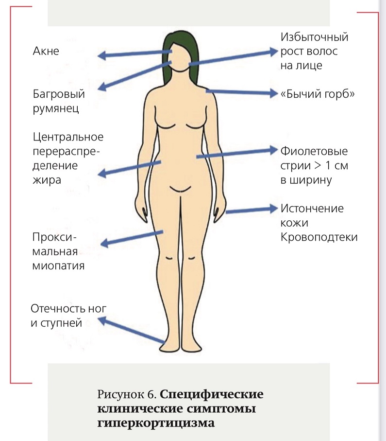 giperkorticizm 6 50101220