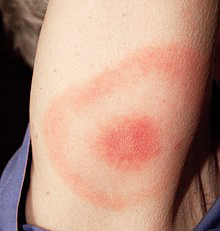 2007.James Gathany..This 2007 photograph depicts the pathognomonic erythematous rash in the pattern of a “bull’s-eye”, which manifested at the site of a tick bite on this Maryland woman’s posterior right upper arm, who’d subsequently contracted Lyme disease.Lyme disease patients who are diagnosed early, and receive proper antibiotic treatment, usually recover rapidly and completely. A key component of early diagnosis is recognition of the characteristic Lyme disease rash called erythema migrans. This rash often manifests itself in a “bull's-eye” appearance, and is observed in about 80% of Lyme disease patients...Lyme disease is caused by the bacterium Borrelia burgdorferi, and is transmitted to humans by the bite of infected blacklegged ticks. Typical symptoms include fever, headache, fatigue, and as illustrated here, the characteristic skin rash called erythema migrans. If left untreated, infection can spread to joints, the heart, and the nervous system. Note that there are a number of PHIL images related to this disease and its vectors.
