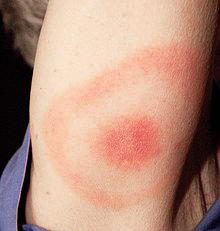 2007.James Gathany..This 2007 photograph depicts the pathognomonic erythematous rash in the pattern of a “bull’s-eye”, which manifested at the site of a tick bite on this Maryland woman’s posterior right upper arm, who’d subsequently contracted Lyme disease.Lyme disease patients who are diagnosed early, and receive proper antibiotic treatment, usually recover rapidly and completely. A key component of early diagnosis is recognition of the characteristic Lyme disease rash called erythema migrans. This rash often manifests itself in a “bull's-eye” appearance, and is observed in about 80% of Lyme disease patients...Lyme disease is caused by the bacterium Borrelia burgdorferi, and is transmitted to humans by the bite of infected blacklegged ticks. Typical symptoms include fever, headache, fatigue, and as illustrated here, the characteristic skin rash called erythema migrans. If left untreated, infection can spread to joints, the heart, and the nervous system. Note that there are a number of PHIL images related to this disease and its vectors.