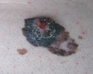 melanoma 191621
