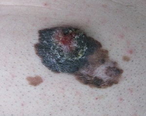 melanoma 191621