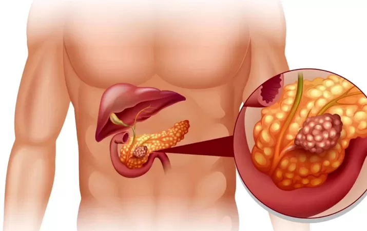 Рак поджелудочной железы: проблемы и решения. Современный подход